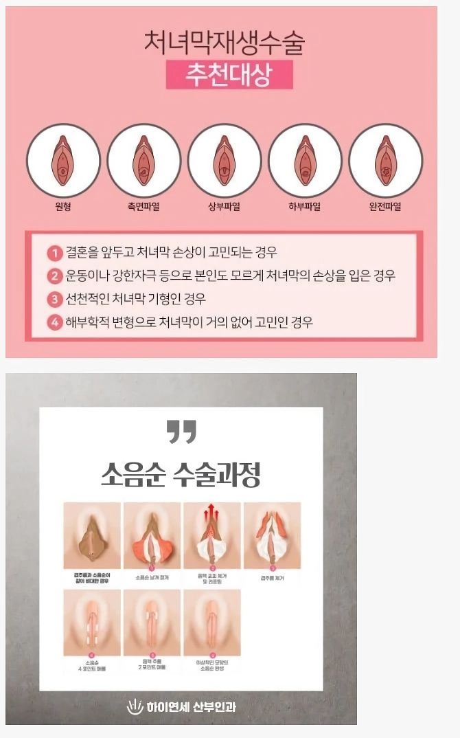 19) 젊은 여성들 사이에서 은근 인기 있는 수술.