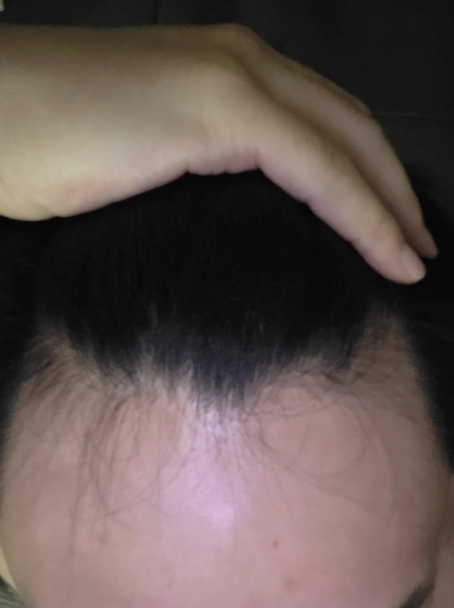 탈모일까요?