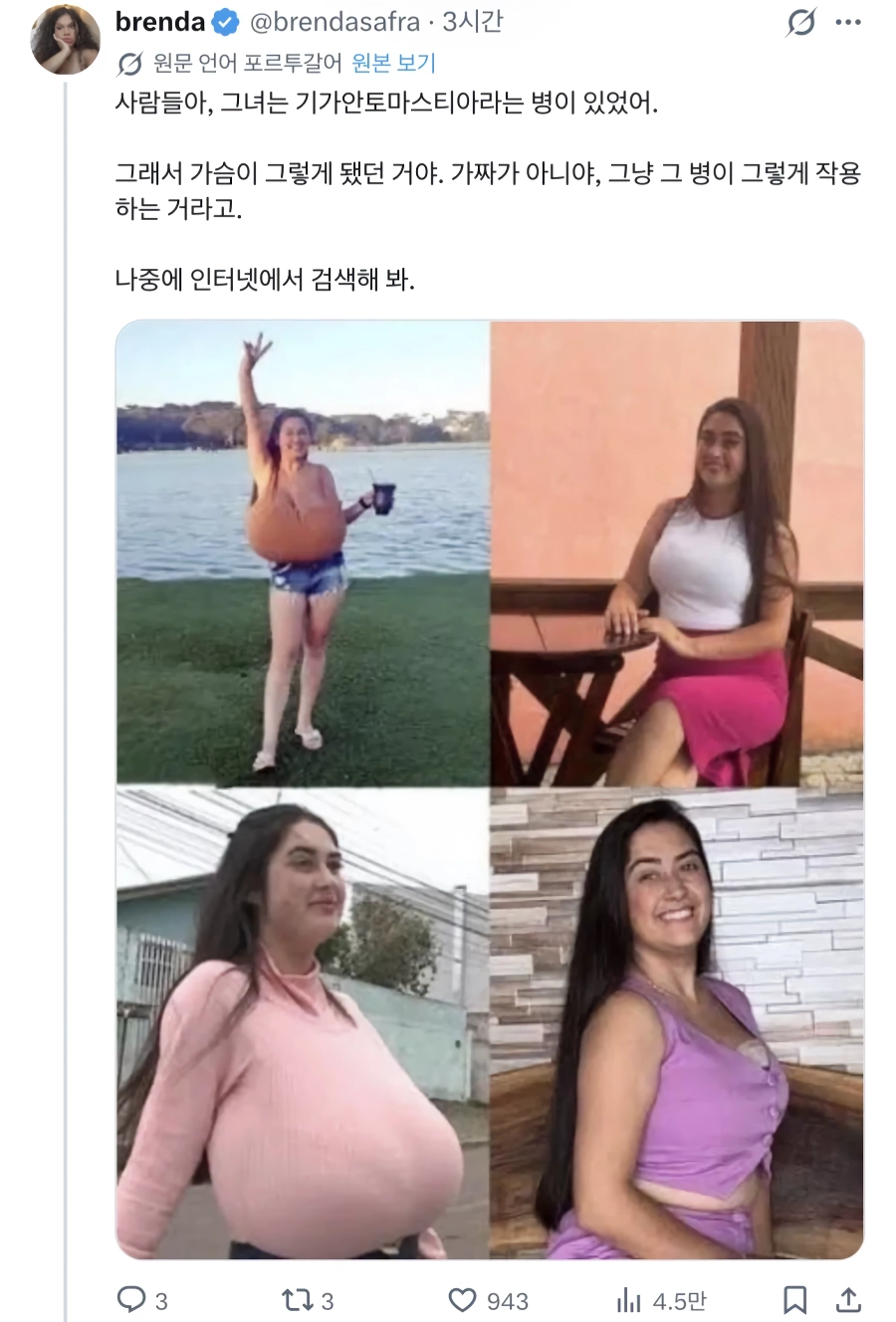 (SOUND)거대유방증을 앓은 여성의 수술 비포 애프터