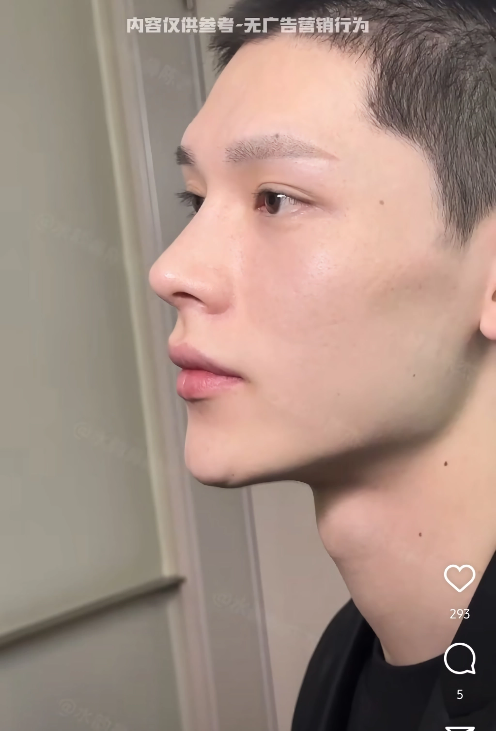 남자 코수술 레전드