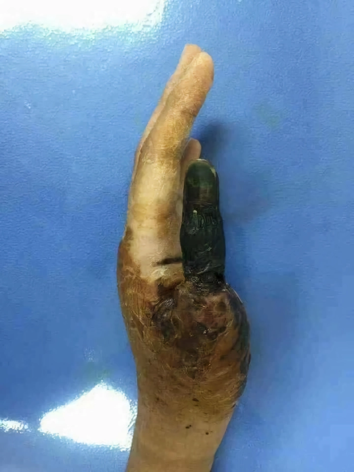 (ㄹㅇ혐 경고) 중국에서 “”””오보사”””” 라고 불리는 독사에게 물린 남성