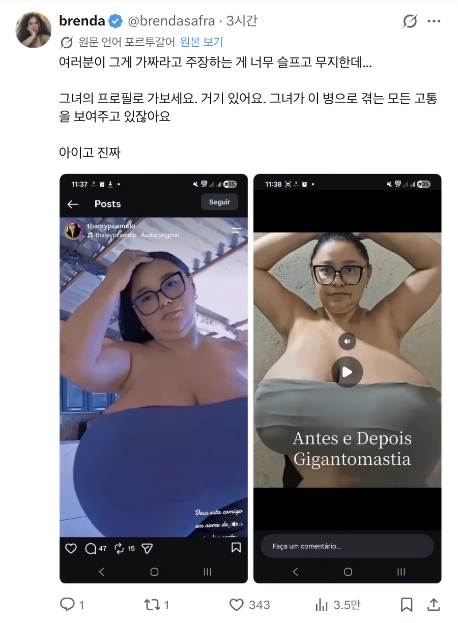(SOUND)거대유방증을 앓은 여성의 수술 비포 애프터