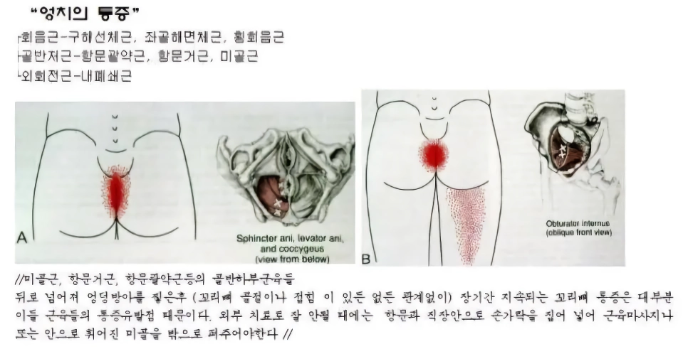 항문에 직접손을 넣어 척추교정하는 미골교정.jpg