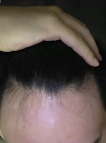 탈모일까요?